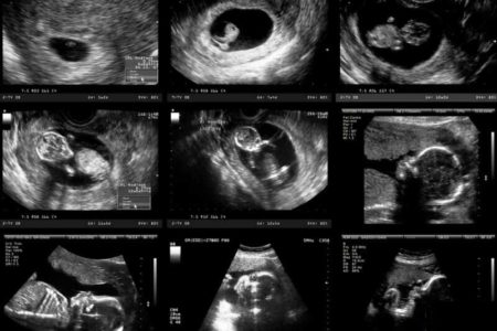همه چیز درباره سونوگرافی‌های دوران بارداری