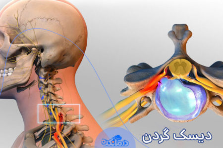 دیسک گردن چیست؟ علائم و روش‌های درمان کاربردی